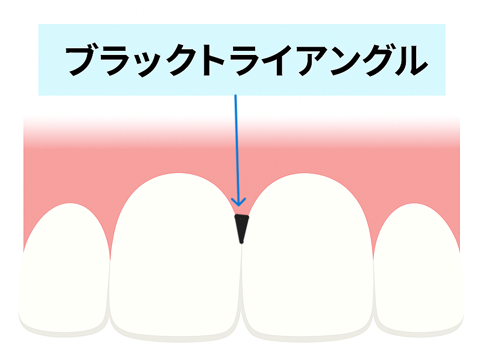 ブラックトライアングルのイメージイラスト