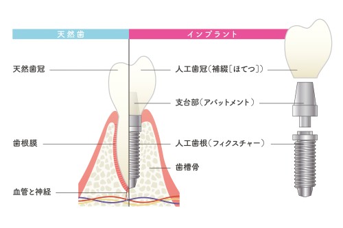 インプラントの構造